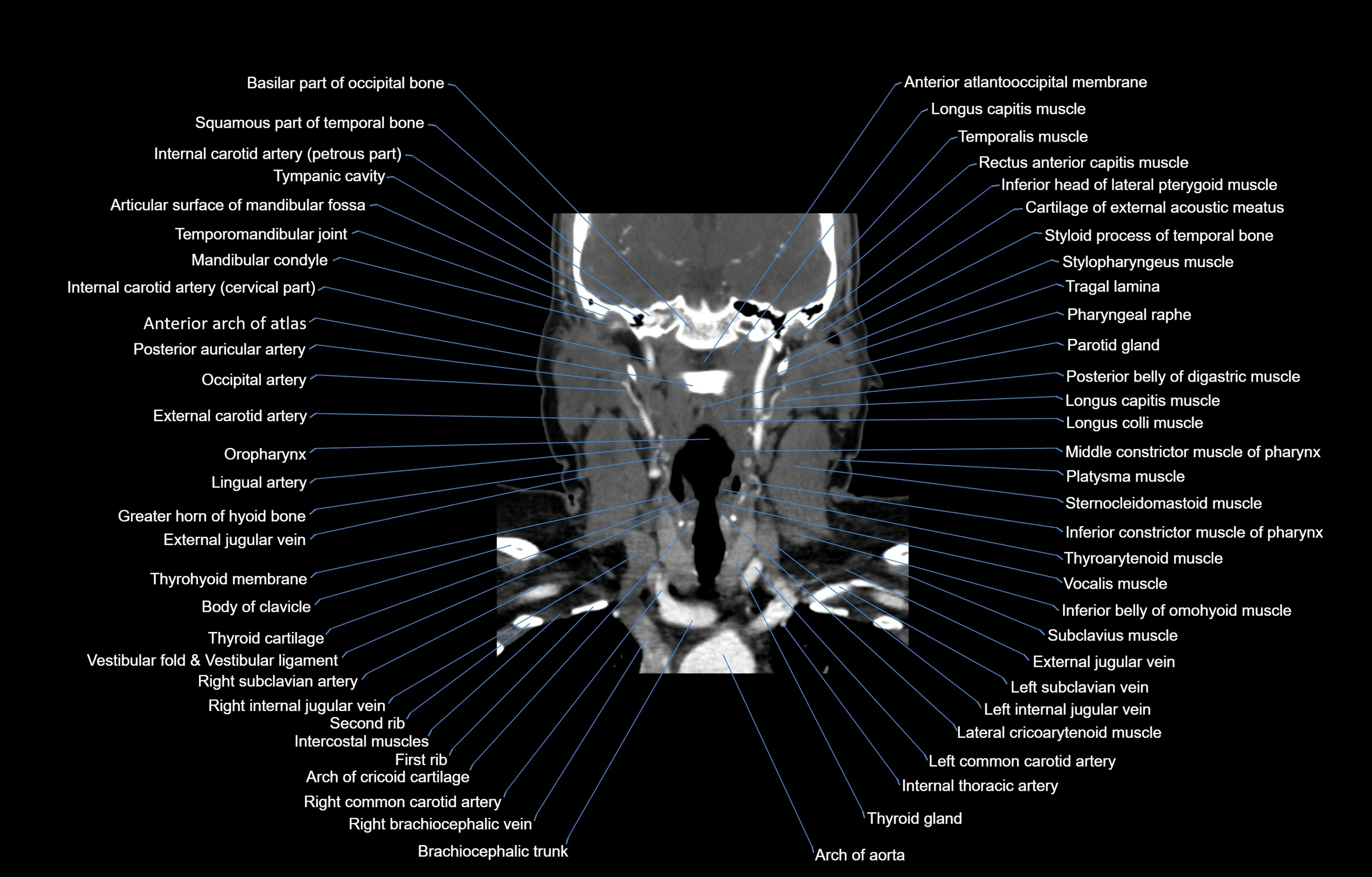 CT Neck coronal  cross sectional anatomy labelled 3D  radiology  image-00035.webp